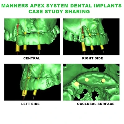 „Manners“ viršūnės sistemos neatidėliotina implantacija į priekinę žandikaulį...