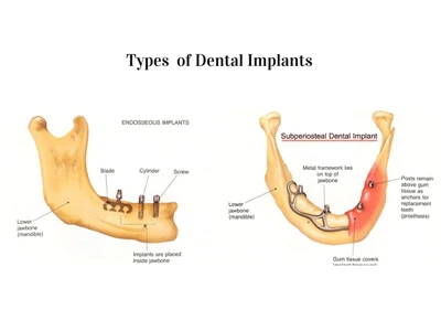 Šiuolaikinė dantų implantologija: implantų klasifikacija