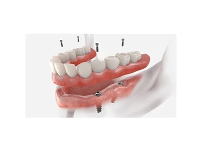 Kokie yra dantų implantų tipai?