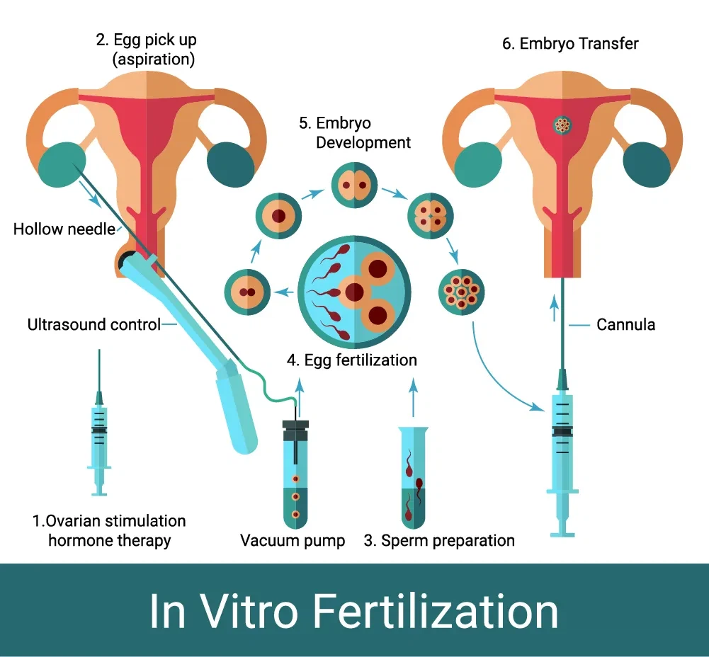 Įvairių dydžių kiaušinių gavimo adatų efektyvumas IVF procedūrose